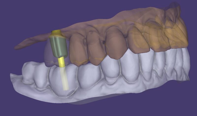 titanium abutment zirkonium kroon